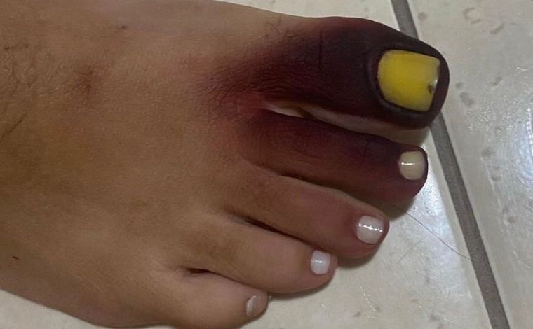 Carioca fica com pé roxo e unha amarela após calçar tênis com piolho-de-cobra