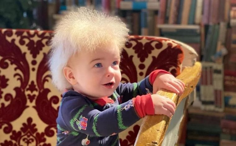 Bebê com ‘síndrome do cabelo impenetrável’ faz sucesso na internet com fios arrepiados; veja fotos
