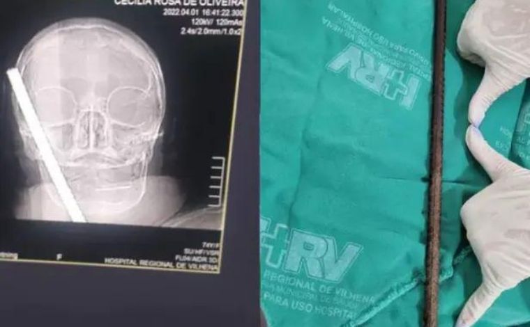 Idosa de 74 anos sobrevive após cair em calçada e ter crânio perfurado por vergalhão de 30 cm