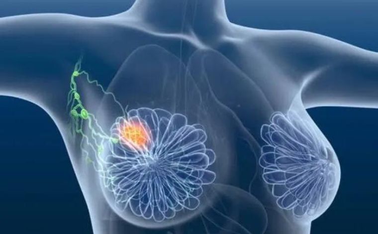 Foto: ReproduÃ§Ã£o - Os cientistas fizeram aplicaÃ§Ã£o de imunotoxina diretamente nos dutos mamÃ¡rios de pessoas com a doenÃ§a em estÃ¡gio inicial. Os resultados apontaram reduÃ§Ã£o total de lesÃµes prÃ©-cancerosas visÃ­veis e invisÃ­veis de pacientes