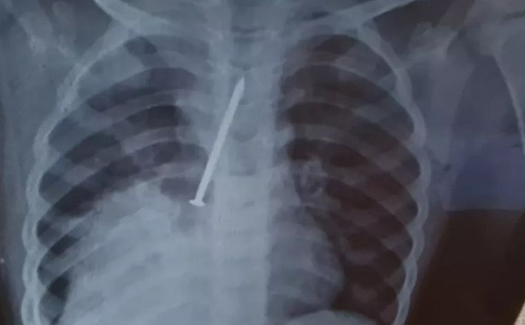 Criança de 3 anos morre após passar um ano com prego no pulmão