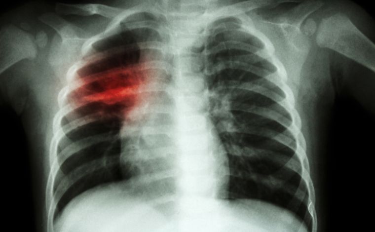 Tuberculose pulmonar ultrapassa fronteiras de presídios e favelas no Brasil