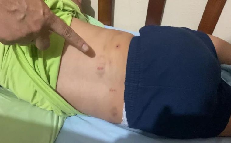 Menino de 2 anos fica com hematomas no corpo ao ser mordido em creche no interior de Minas 