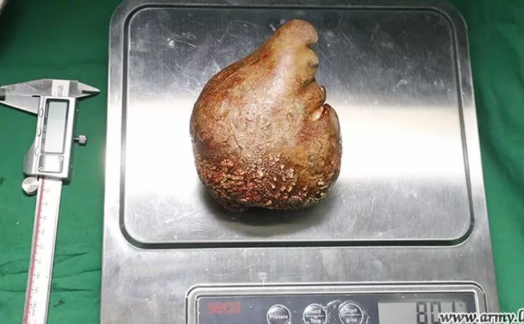 Pesando 801g, médicos removem maior pedra renal já registrada no mundo