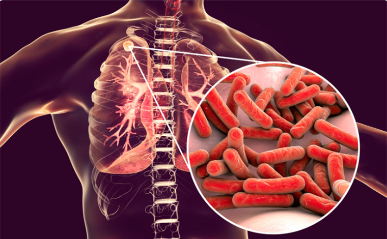 Tuberculose nos ossos, rins e cérebro? Entenda a forma extrapulmonar da doença