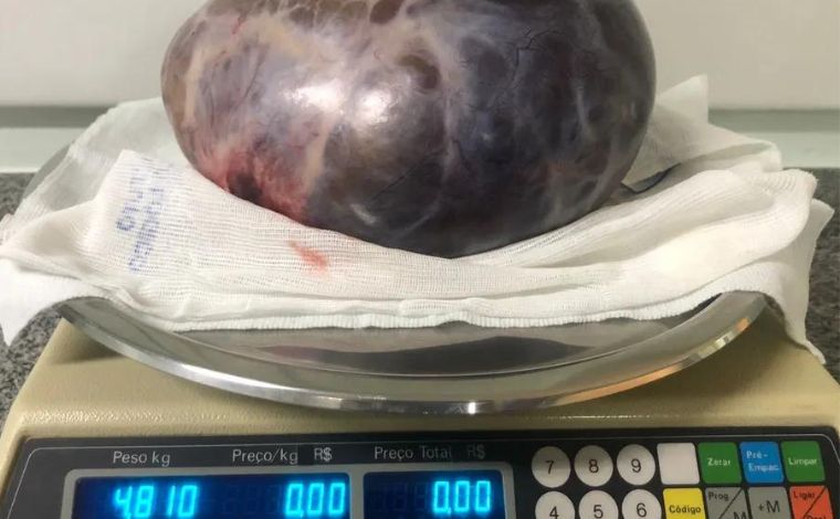 Tumor de quase 5 Kg é retirado do ovário de mulher em cirurgia de emergência em Minas Gerais