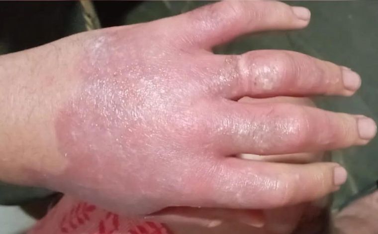Homem sofre queimadura de segundo grau por uso de limão e exposição da mão ao sol em MG