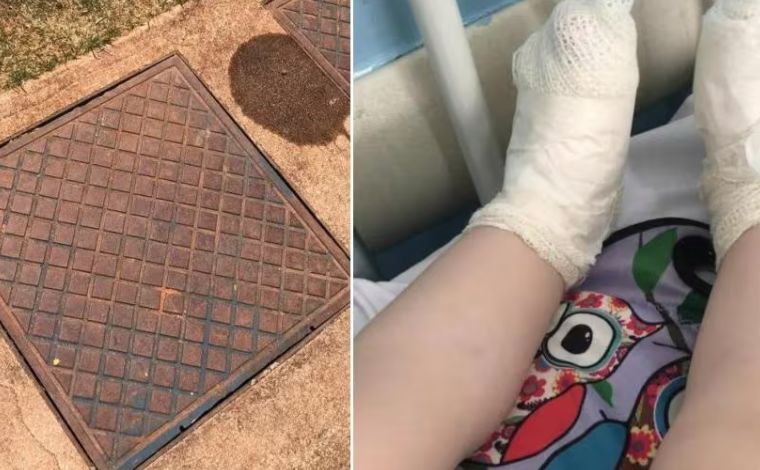 Menina de 3 anos sofre queimadura após pisar em tampa de ferro superaquecida em Minas 