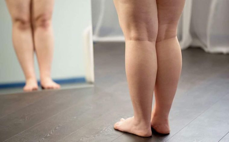 Conheça doença que provoca deformação corporal e é confundida com obesidade