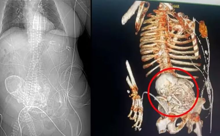 Idosa descobre feto calcificado que carregou por mais de 50 anos e morre após cirurgia de retirada