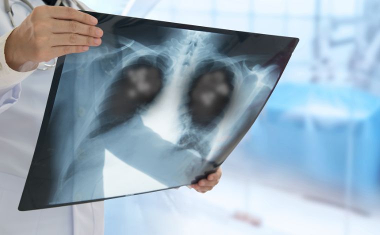 Foto: Getty Images - As trÃªs doenÃ§as respiratÃ³rias mais comuns â gripe, sÃ­ndrome respiratÃ³ria aguda grave (SRAG) e pneumonia â compartilham sinais clÃ­nicos que confundem atÃ© mesmo pacientes mais atentos