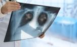 Gripe, síndrome respiratória ou pneumonia? Veja como diferenciar sintomas e entender riscos