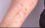 Três escolas de Sete Lagoas registram suspeitas de Mpox e adotam medidas preventivas
