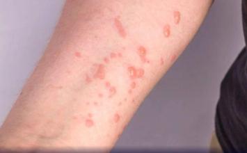 Três escolas de Sete Lagoas registram suspeitas de Mpox e adotam medidas preventivas