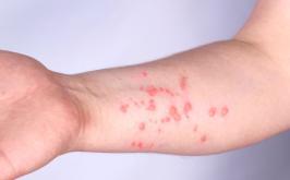 Sete Lagoas atualiza situação de dois casos suspeitos de mpox; pacientes apresentam melhora