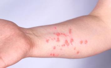 Sete Lagoas atualiza situação de dois casos suspeitos de mpox; pacientes apresentam melhora