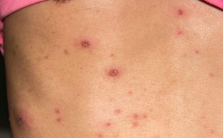 Casos investigados como Mpox em Sete Lagoas são confirmados como Varicela (catapora)