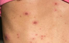 Casos investigados como Mpox em Sete Lagoas são confirmados como Varicela (catapora)