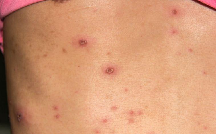 Casos investigados como Mpox em Sete Lagoas são confirmados como Varicela (catapora)