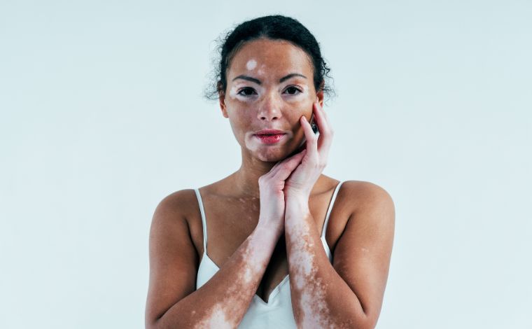 Dia Mundial do Vitiligo chama atenção para impactos físicos, emocionais e sociais da condição 