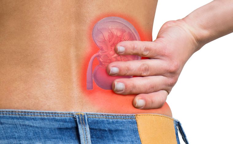 Foto: Getty Images - Pedras nos rins costumam ser assintomÃ¡ticas, mas podem causar dor intensa quando obstruem a via urinÃ¡ria e provocam distensÃ£o da cÃ¡psula renal