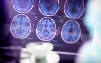 Alzheimer: Nova técnica de imagem detecta sinais precoces antes dos sintomas
