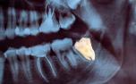Dente do siso: 6 mitos e verdades que você precisa saber