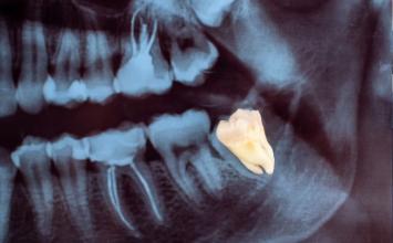 Dente do siso: 6 mitos e verdades que você precisa saber