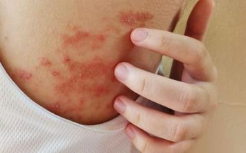 Cicatrizes da alma: quando trauma psicológico vira dermatite