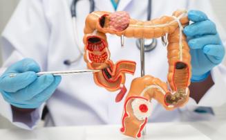 Câncer de intestino cresce entre jovens; conheça fatores de risco