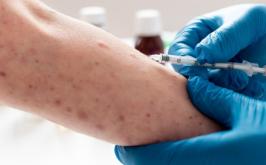 Minas Gerais confirma três casos de mpox em 2026