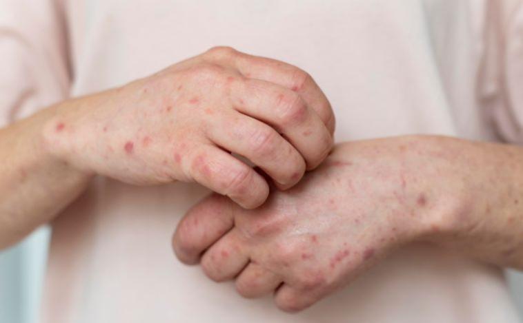 Minas Gerais confirma sete casos de mpox em 2026