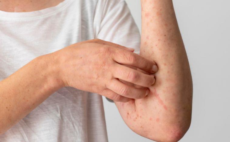 Mpox: sobe para 13 o número de casos da doença em Minas Gerais