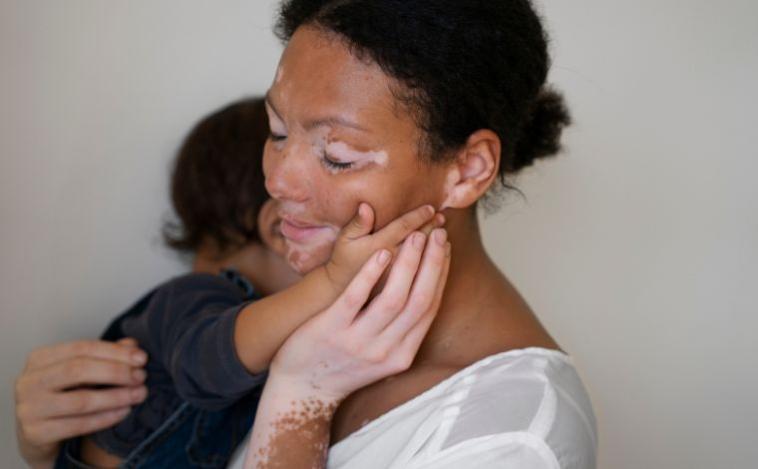 Vitiligo tem causa genética? Entenda 7 mitos e verdades sobre a condição
