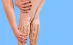Celulite e lipedema: entenda diferenças e formas de tratamento