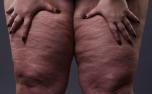 Confundido com obesidade, lipedema atinge mais de 12% das mulheres brasileiras