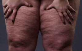 Confundido com obesidade, lipedema atinge mais de 12% das mulheres brasileiras