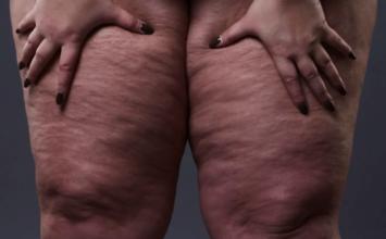 Confundido com obesidade, lipedema atinge mais de 12% das mulheres brasileiras