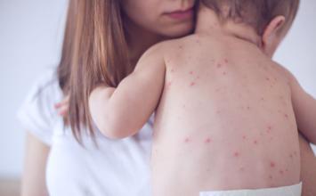 Especialista alerta para risco de pneumonia e sequelas neurológicas causadas pelo sarampo