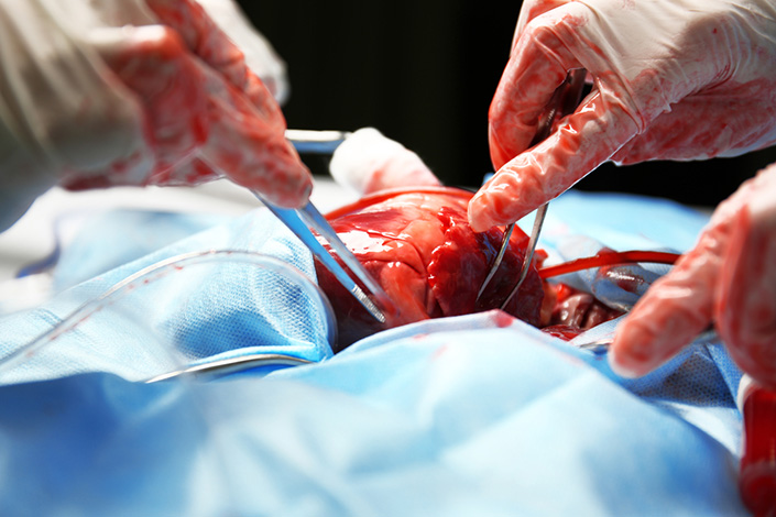 Crise econômica afeta número de transplantes de órgãos em todo o país
