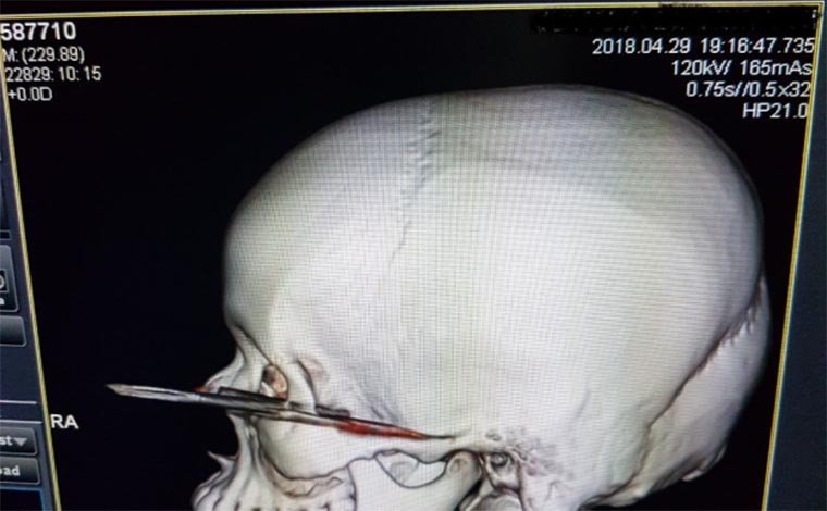 Ex-namorado atinge mulher com facada no olho em Vespasiano