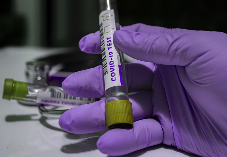 Boletim Epidemiológico: Sete Lagoas registra 14 novos casos de Covid-19 nas últimas 48 horas
