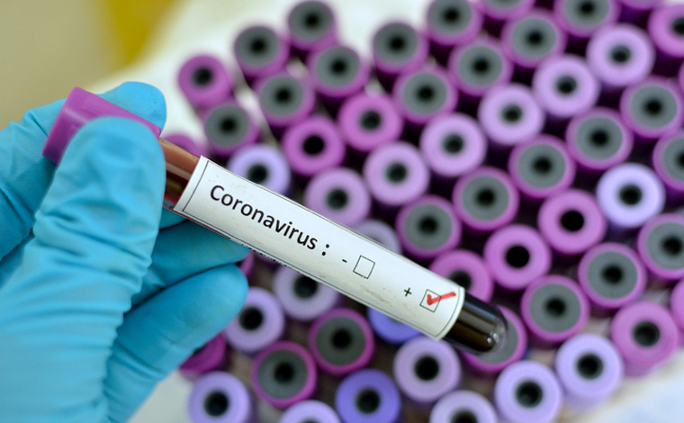 Boletim Epidemiológico: Sete Lagoas registra mais 30 novos casos de Covid-19 nas últimas 24 horas