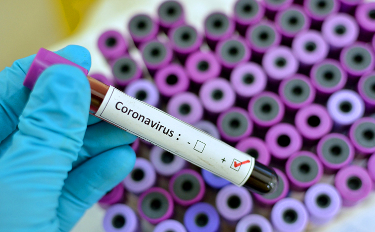 Boletim Epidemiológico: Sete Lagoas registra mais dois óbitos e 427 novos casos de Covid-19 